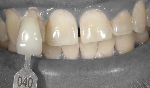 AFTER - ZOOM! WHITENING